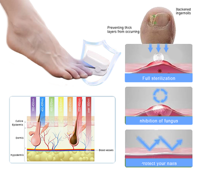 ZehenLicht™ Lichttherapiegerät für Zehennagelerkrankungen