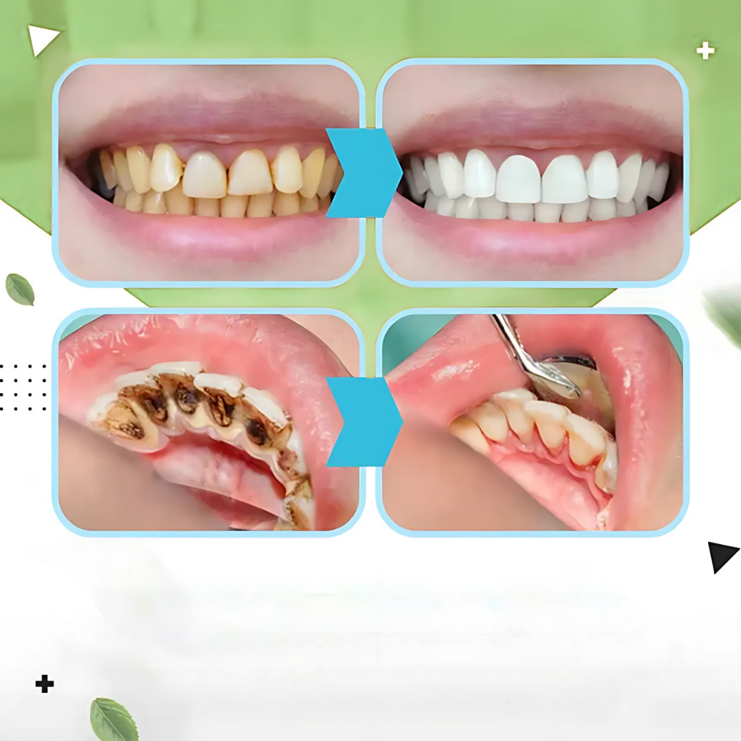 TLOPA Ampullenzahnpasta | Whitening Zahnpasta | Minzgeschmack | Sanfte Formel | 1 Stück | 50% Rabatt