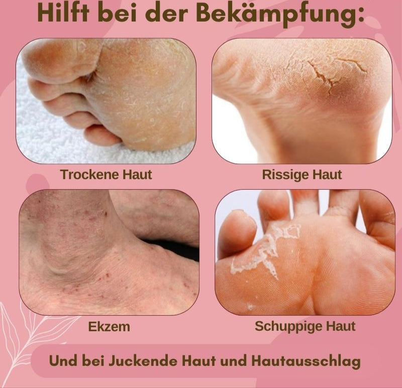 1+1 Gratis | Medizinische Fußpflegecreme | Gegen Pilz, Ekzeme & rissige Haut | Regenerierend, feuchtigkeitsspendend & mit Arnika