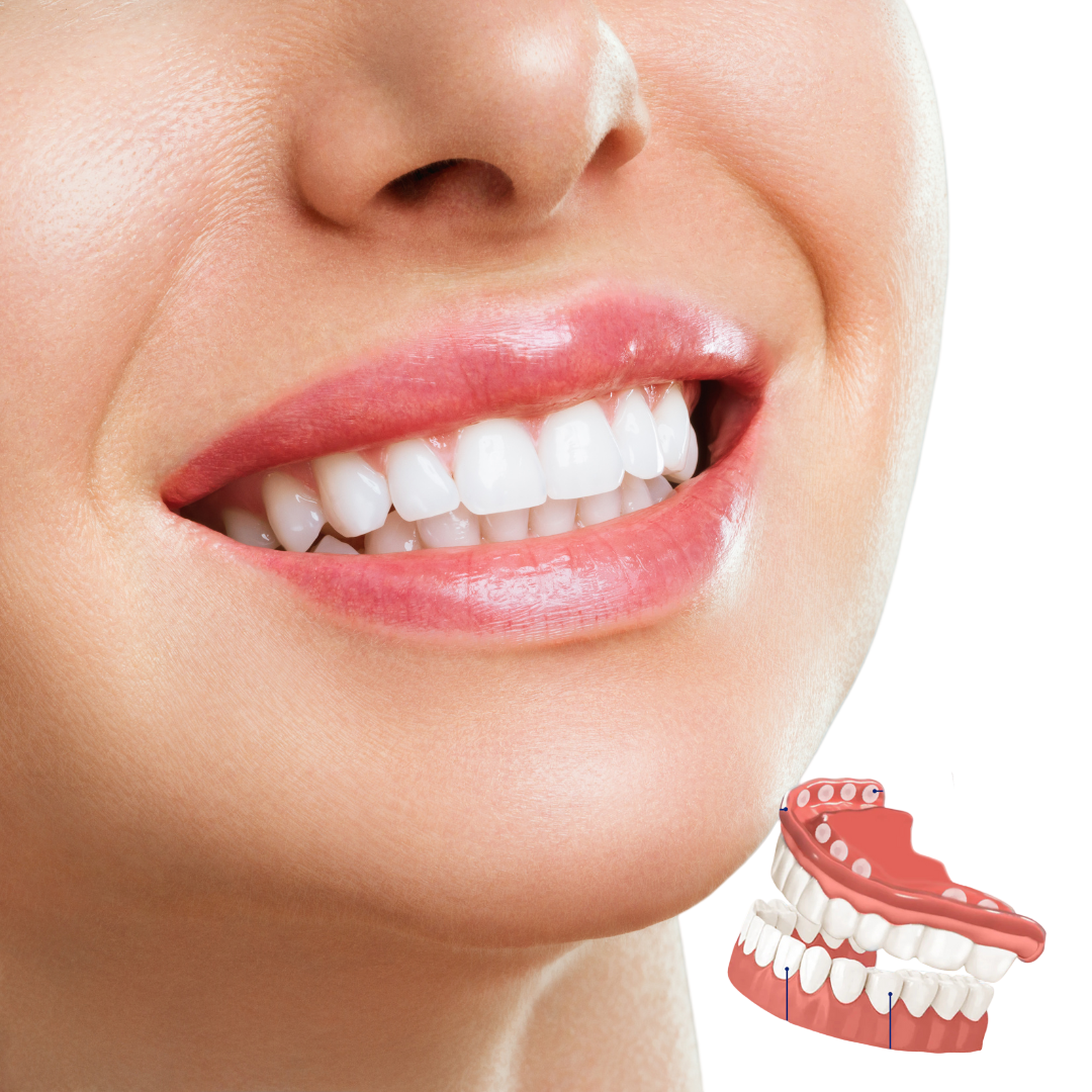 Prothesen Anpassungsset | Flexibles Silikon für sicheren Halt | Komfortabler Sitz | Einfache Anwendung