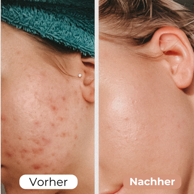 FaltenFrei™ Jugendliche Haut Sofort-Boost