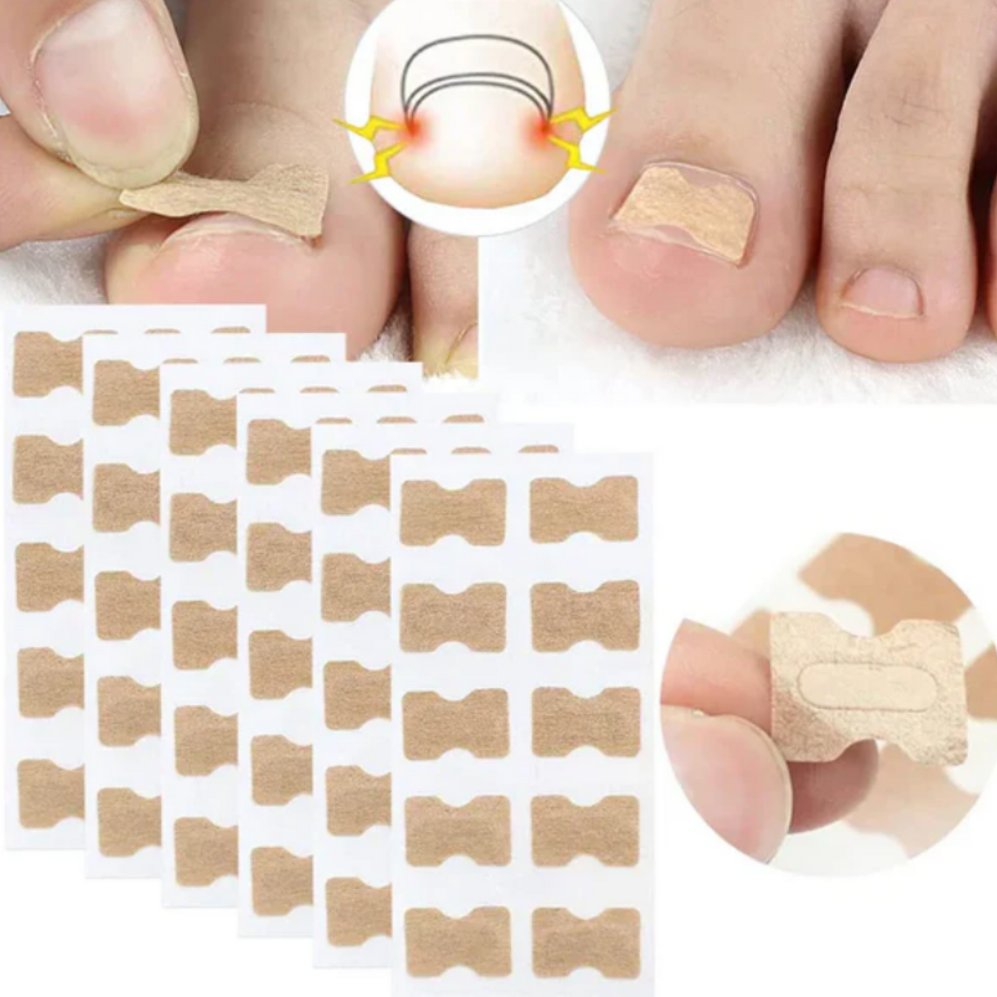 Nagelkorrektur Aufkleber | Behandlung eingewachsener Nägel & Paronychie | Schmerzfreie Nagelpflege