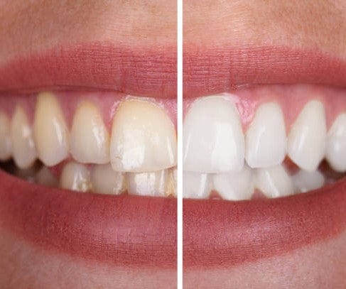 BeautySmiley™  genießen Sie ein strahlend weißes Lächeln ohne Risiko!