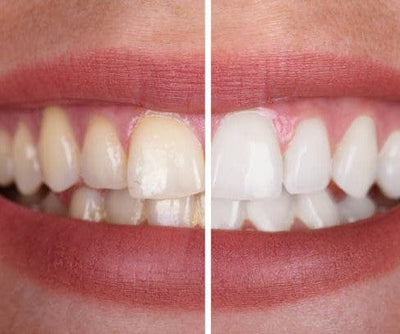 BeautySmiley™  genießen Sie ein strahlend weißes Lächeln ohne Risiko!